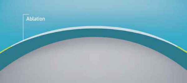 SmartSurf