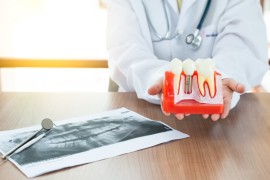 Finansman kolaylıklarıyla implant tedavilerine talep artıyor