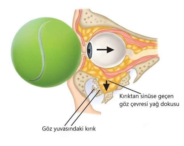 Tenis’te potansiyel tehlike: Blow out kırıkları!