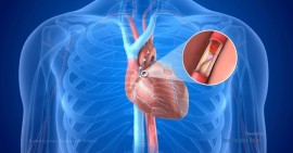 Prof. Dr. Nevrez Koylan Uyarıyor: Koroner Bypass veya Stent Sonrası "Motoru Sıfırladık" Zannetmeyin!