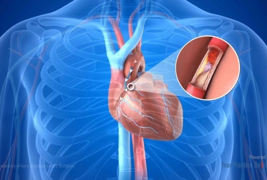 Prof. Dr. Nevrez Koylan Uyarıyor: Koroner Bypass veya Stent Sonrası "Motoru Sıfırladık" Zannetmeyin!